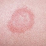 Lyme symptoms