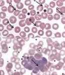 bartonella and lyme symptoms