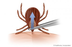 Removing a Tick and lyme symptoms