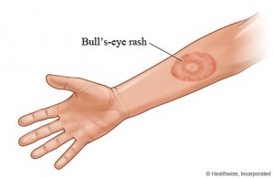 bulls eye rash lyme symptoms