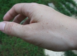 ticks lyme disease