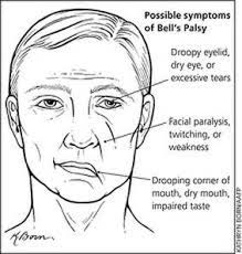 Bells Palsy and Lyme Symptoms